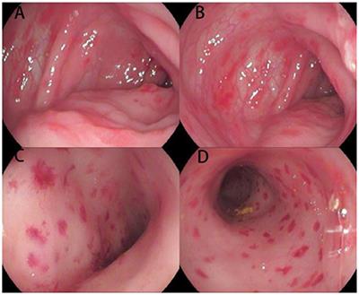 Case Report: Two Infant Cases of Langerhans Cell Histiocytosis Involving the Digestive Tract